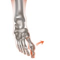 Valgus deformity of the big toe. Bones on the feet or bumps on the feet, gout.